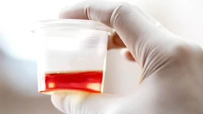 دلایل خون ادراری چیست