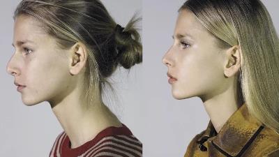 مزایای انجام عمل بینی نیمه فانتزی