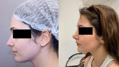 انواع جراحی بینی