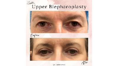 راهنمای کامل بلفاروپلاستی: از مشاوره تا بهبودی