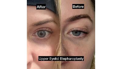 راهنمای کامل بلفاروپلاستی: از مشاوره تا بهبودی