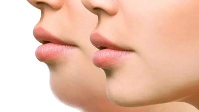 هزینه عمل لیپوساکشن