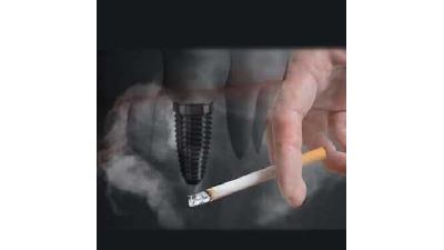 تاثیر سیگار در میزان موفقیت ایمپلنت دندان