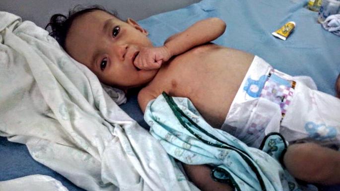 سوتغذیه و نبود دارو جان کودکان ونزوئلا را می‌گیرد