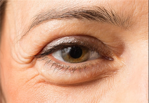 چگونه پف زیر چشم‌ها را از بین ببریم