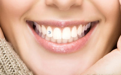 کاشت نگین روی دندان آسیبی وارد نمی‌کند