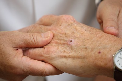 نشانه‌های سرطان پوست