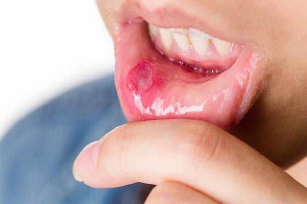 آنچه درباره آفت دهان باید بدانید