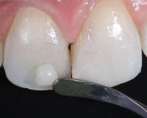 کامپوزیت؛  بهترین و ارزان‌ترین راه برای ترمیم و زیبایی دندان‌