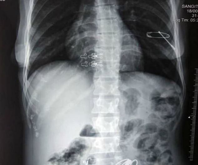 خروج بیش از ۱.۵ کیلو اشیا فلزی از معده یک پیرزن