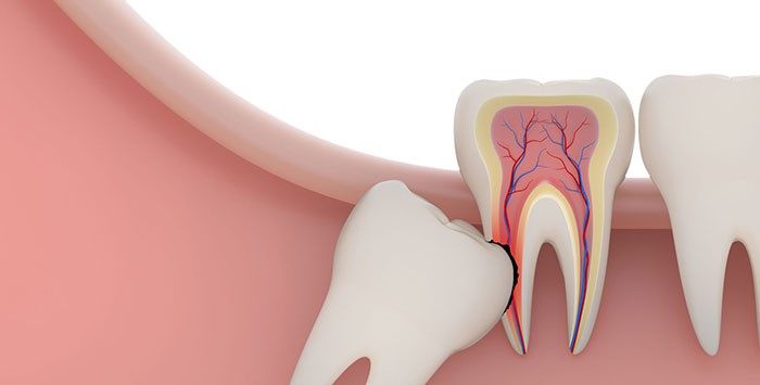 نکشیدن دندان عقل چه عوارضی دارد؟