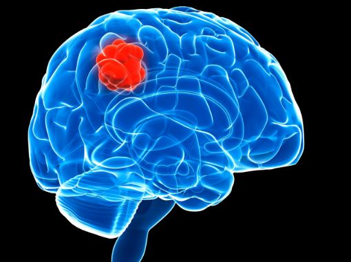 علایم ابتلا به سرطان مغز چیست؟