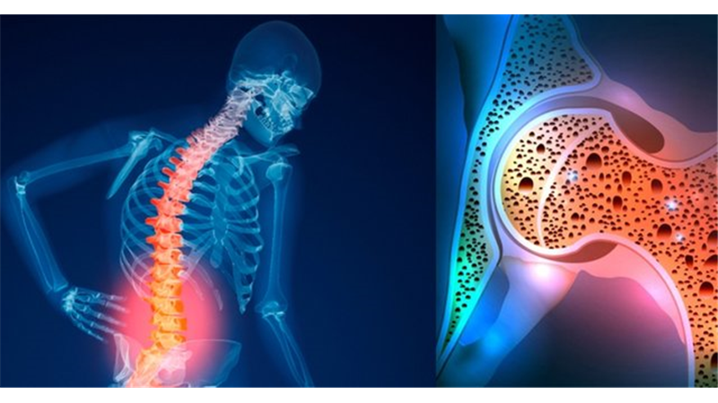 دلایل پوکی استخوان چیست