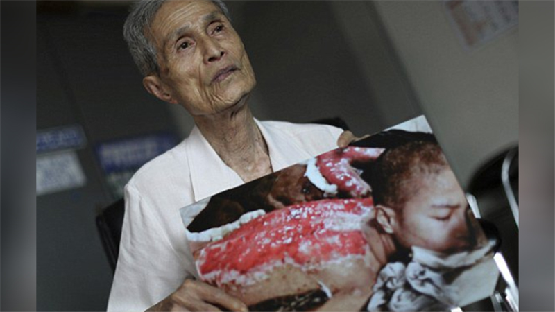 زندگی دردناک بازمانده بمباران اتمی ناکازاکی با درد‌های ۷۰ ساله