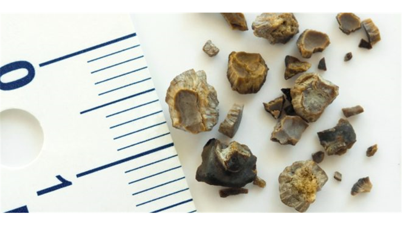 مفیدترین خوراکی‌ها برای دفع سنگ کلیه با درد کمتر