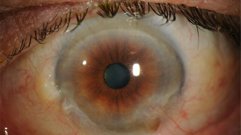 دلیل آب مروارید چشم چیست و مراقبت‌های بعد از عمل چگونه است