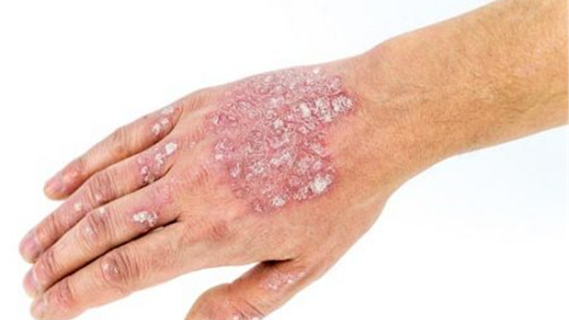 دلایل ابتلا به اگزما و راه درمان