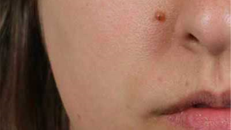 دلیل ایجاد خال‌های گوشتی روی پوست چیست