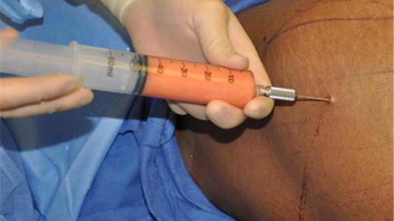 آیا ساکشن چربی‌های زائد بدن عارضه دارد؟