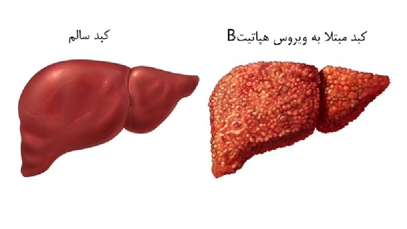 هپاتیت ب چه علایمی دارد و چطور  منتقل می‌شود
