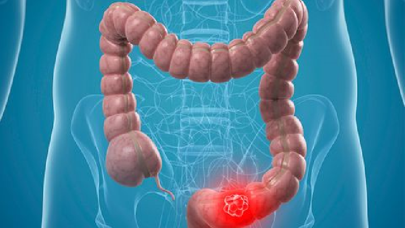  علایم سرطان روده بزرگ چیست؟