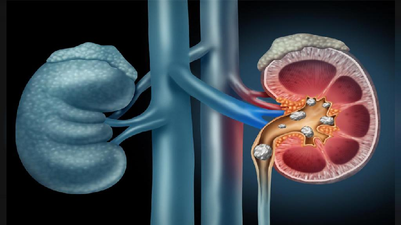 درمان سنگ کلیه بدون نیاز به دارو