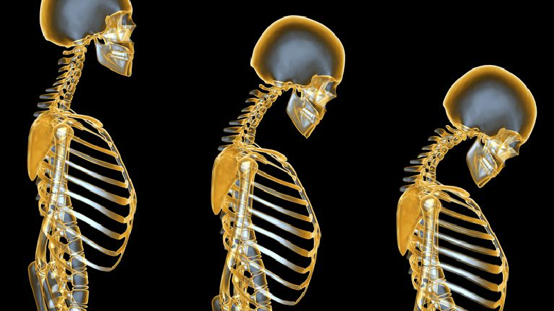 راه پیشگیری از پوکی استخوان + شیوه تشخیص