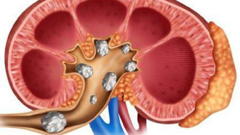 بهترین درمان‌های خانگی سنگ کلیه