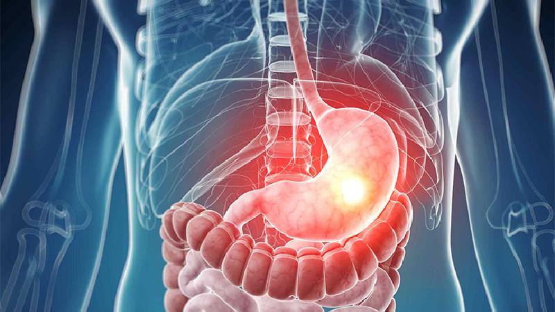 علائم زخم اثنی عشر و راه‌های درمان آن چیست