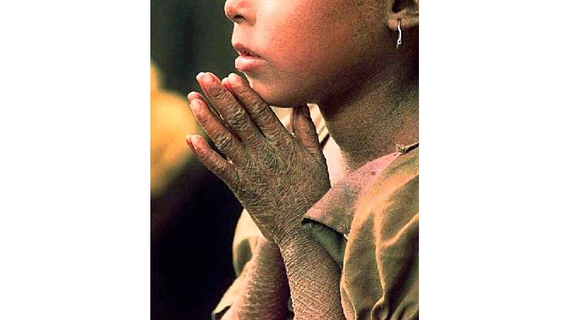 جذام چیست و چه کسانی به آن مبتلا می‌شوند