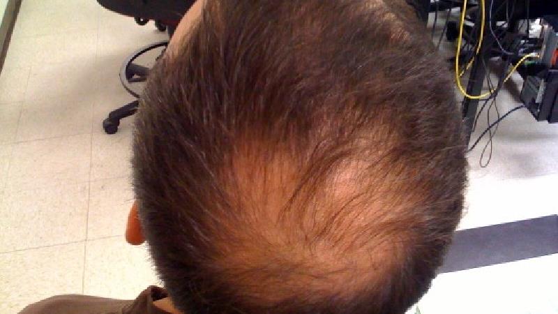 دلایل آلوپسی چیست و درمان آن چگونه است