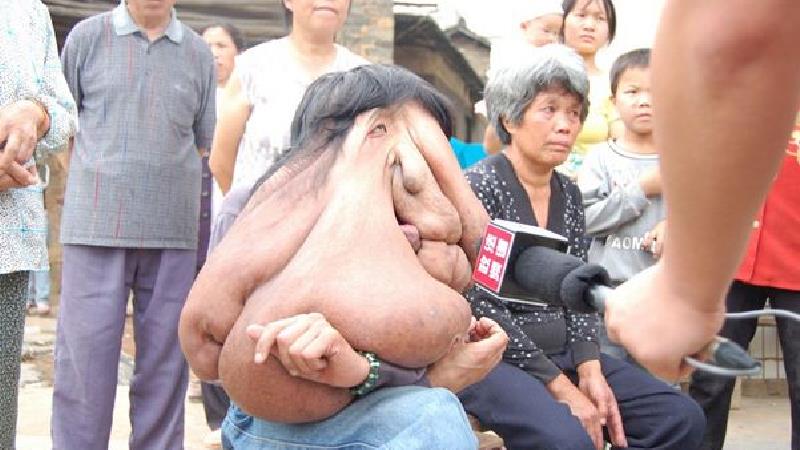 زشت‌ترین فرد جهان را ببنید + دلیل بیماری