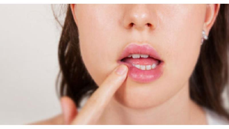 تبخال لب و صورت؛ دلایل و درمان‌های خانگی