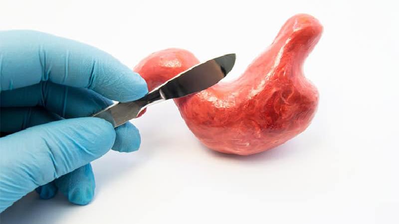 عمل اسلیو  معده چیست و چه  خوبی ها و بدی‌هایی دارد