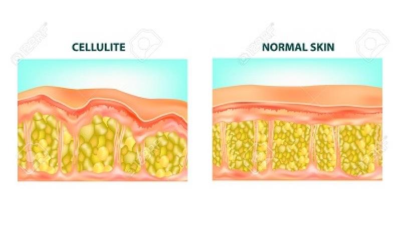 سلولیت چیست و چگونه درمان می‌شود