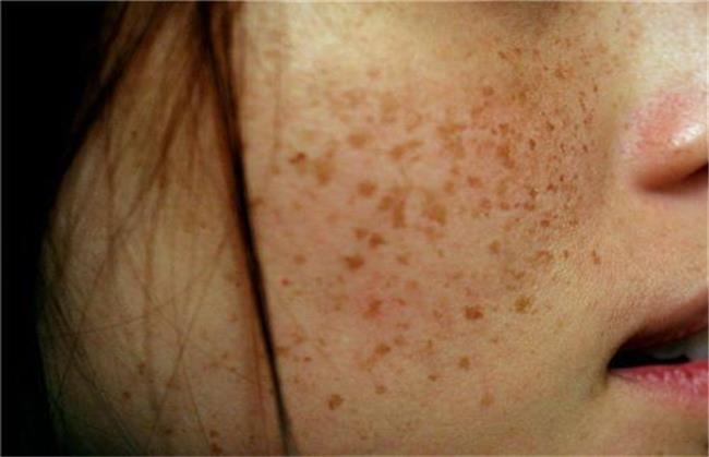 آیا کک و مک را می‌توان با لیزر از بین برد/ این کار چه ضررهایی دارد