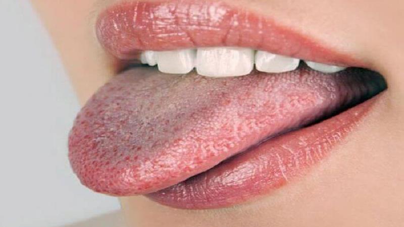 علت سفیدی زبان چیست و چه باید کرد
