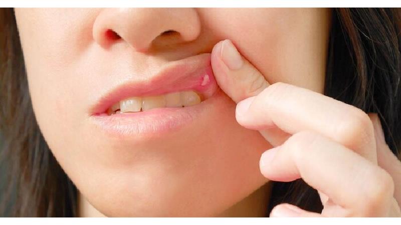 دلیل آفت دهان و روش درمان خانگی و سنتی آن چیست