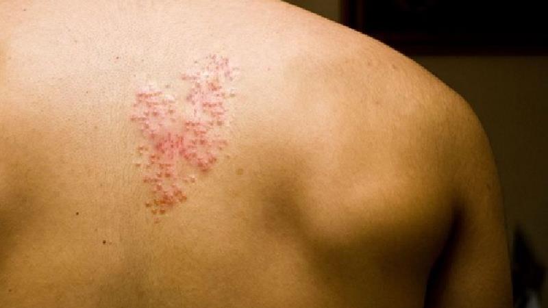 آیا زونا واگیر دارد