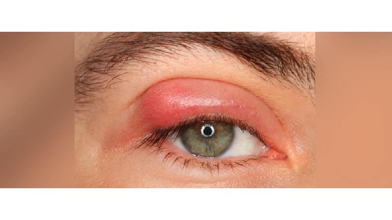 گل مژه چیست و چطور آن را در خانه درمان کنیم