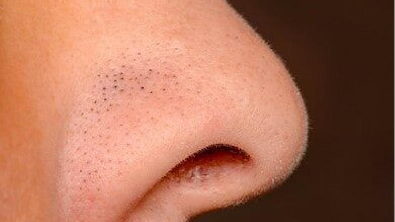 جوش سر سیاه را چگونه از بین ببریم؛ درمان‌های خانگی