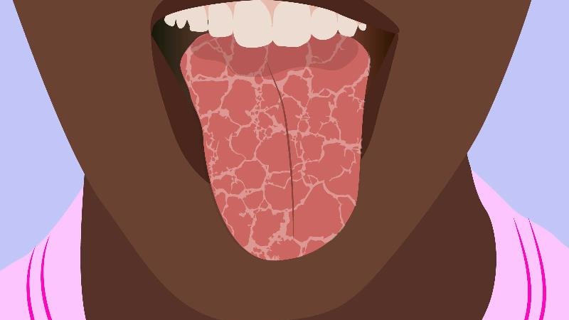 خشکی دهان نشانه چیست