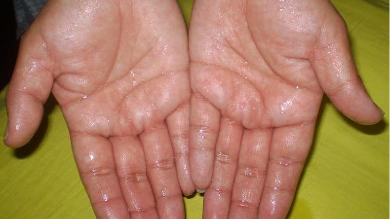 علت عرق کردن کف دست یا هیپرهیدروزیس چیست