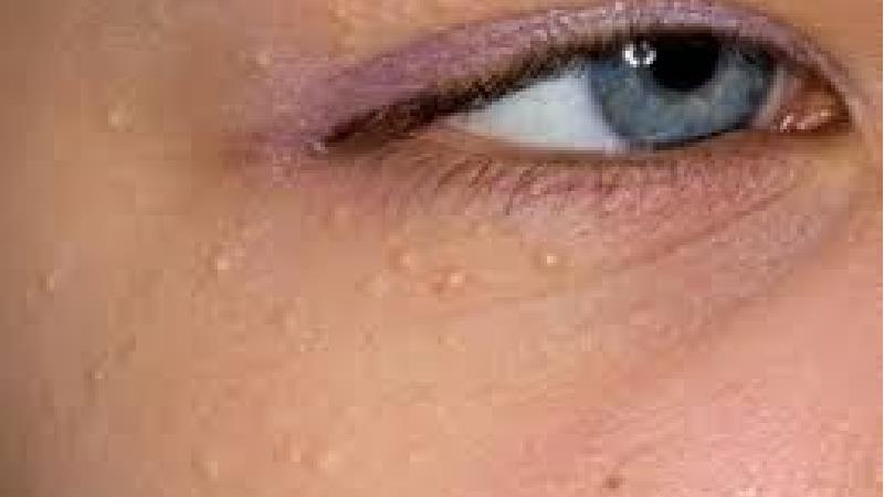 علت و راه درمان بیماری پوستی میلیا چیست