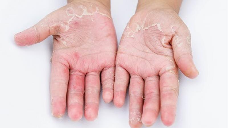 برای پوسته پوسته شدن پوست چه کنیم؛ نسخه طب سنتی