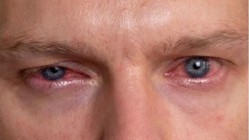 قرمزی چشم‌ چه دلایلی دارد و چه باید کرد