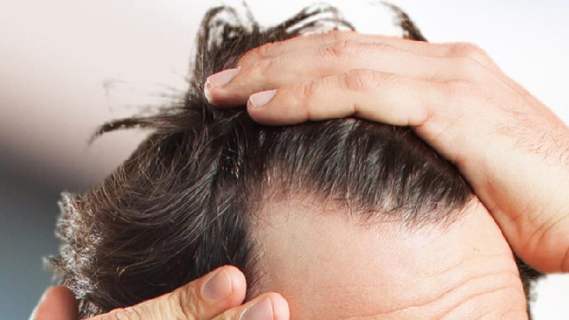 مهم‌ترین نکات برای پیشگیری از ریزش مو در مردان