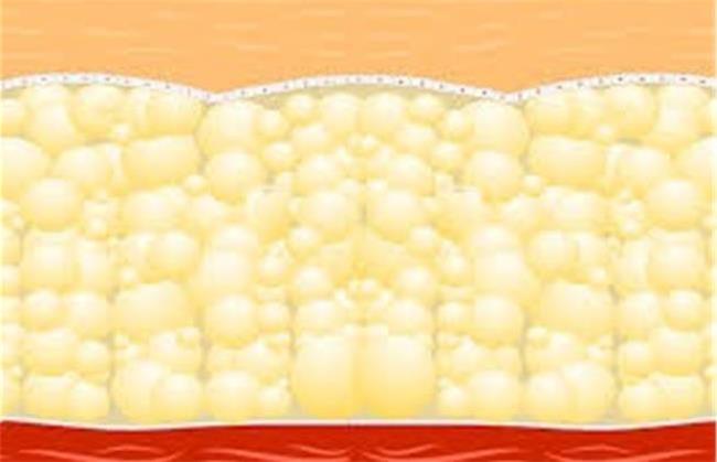 درمان خانگی و گیاهی سلولیت در زنان