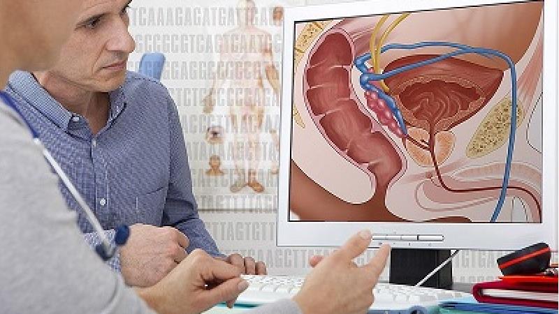 سرطان پروستات؛ علایم و راه‌های تشخیص