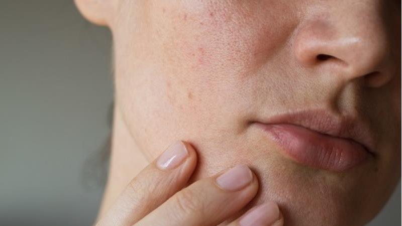 برای پوست خشک چه کنیم؛ راه‌های پیشگیرانه